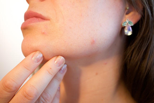 4 Tips to Prevent Acne 